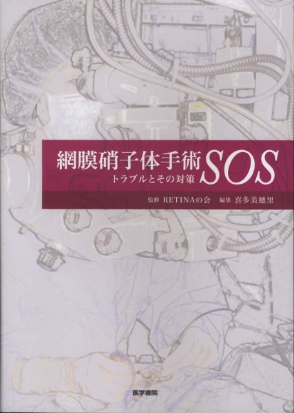 画像1: 網膜硝子体手術SOS トラブルとその対策 (1)