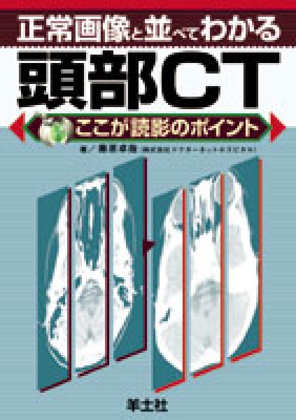 画像1: 正常画像と並べてわかる 頭部CT《正常画像と並べてわかるシリーズ 》 (1)