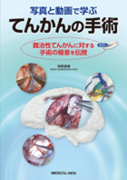 画像1: てんかんの手術　難治性てんかんに対する手術の極意を伝授 (1)