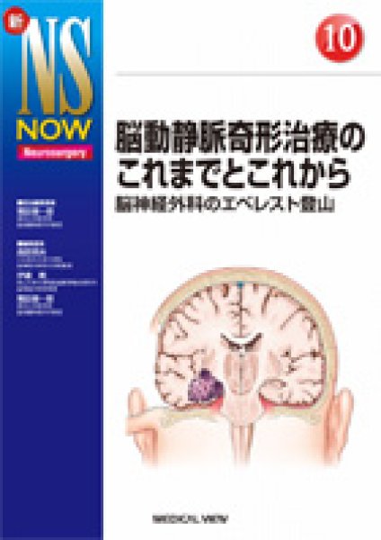 画像1: 【新NS NOW 10】脳動静脈奇形治療のこれまでとこれから (1)