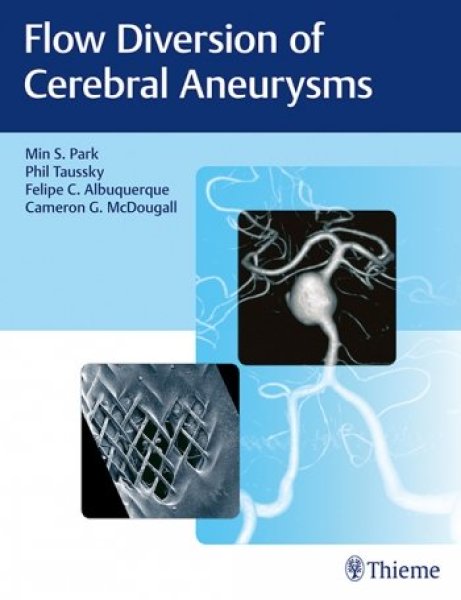 画像1: Flow Diversion of Cerebral Aneurysms (1)