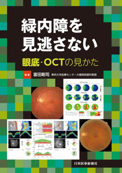 画像1: 緑内障を見逃さない 眼底・OCTの見かた (1)