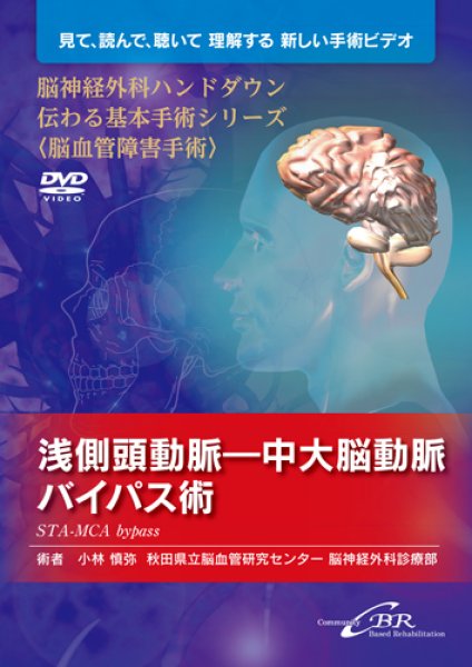 画像1: 【DVD】 脳神経外科ハンドダウン伝わる基本手術シリーズ〈脳血管障害手術〉　浅側頭動脈—中大脳動脈バイパス術―STA-MCA bypass (1)