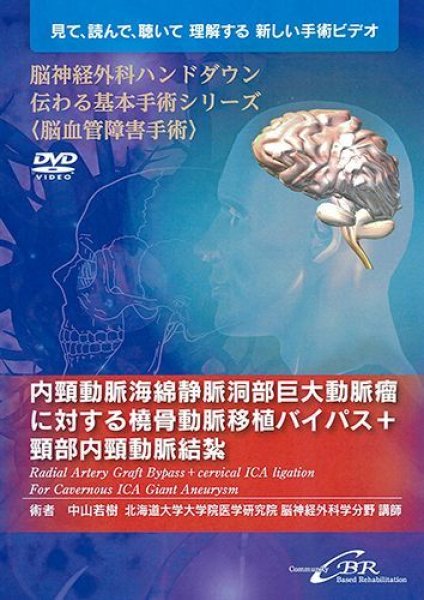 画像1: 【DVD】 脳神経外科ハンドダウン伝わる基本手術シリーズ〈脳血管障害手術〉　内頸動脈海綿静脈洞部巨大動脈瘤に対する橈骨動脈移植バイパス＋頸部内頸動脈結紮―Radial Artery Graft Bypass + cervical ICA ligation For Cavernous ICA Giant Aneurysm (1)