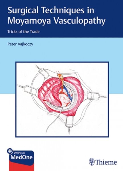 画像1: Surgical Techniques in Moyamoya Vasculopathy: Tricks of the Trade (1)