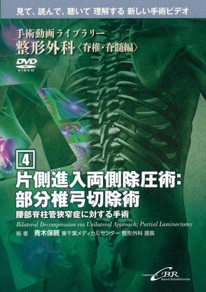 画像1: 【DVD】 片側進入両側除圧術：部分椎弓切除術　Bilateral Decompression via Unilateral Approach; Partial Laminectomy（手術動画ライブラリー　整形外科〈脊椎・脊髄編(4)〉） (1)