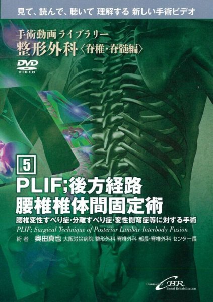 画像1: 【DVD】 PLIF；後方経路腰椎椎体間固定術　PLIF; Surgical Technique of Posterior Lumbar Interbody Fusion（手術動画ライブラリー　整形外科〈脊椎・脊髄編(5)〉） (1)
