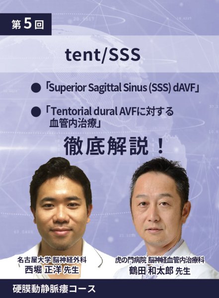 画像1: 動画≫≫≫ GSNET 硬膜動静脈瘻コース5️⃣「tent/SSS」 (1)