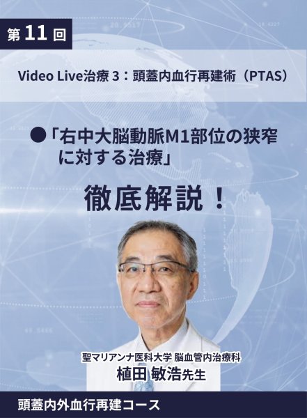 画像1: 動画≫≫≫ GSNET 頭蓋内外血行再建コース11 症例Video 3：頭蓋内血行再建術（PTAS） (1)