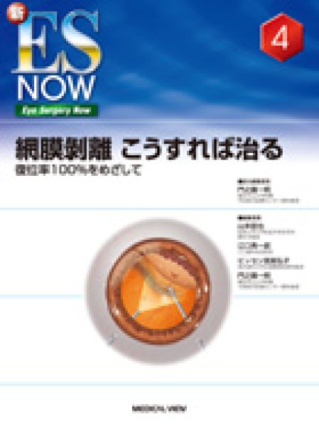 画像1: 網膜剥離　こうすれば治る　復位率100%めざして　[新ES NOW 4] (1)